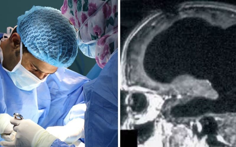 Bí ẩn về người đàn ông mất 90% não, nhưng vẫn có thể sống một cuộc sống bình thường Bí ẩn về người đàn ông mất 90% não, nhưng vẫn có thể sống một cuộc sống bình thường